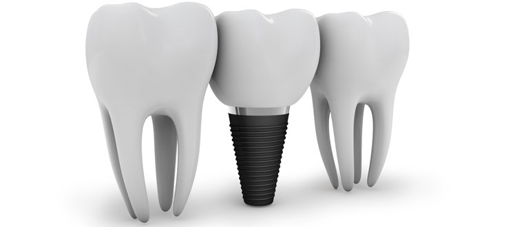 Ideal Choice for Tooth Replacement