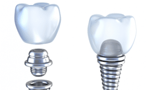 Dental Implants Recovery Tips