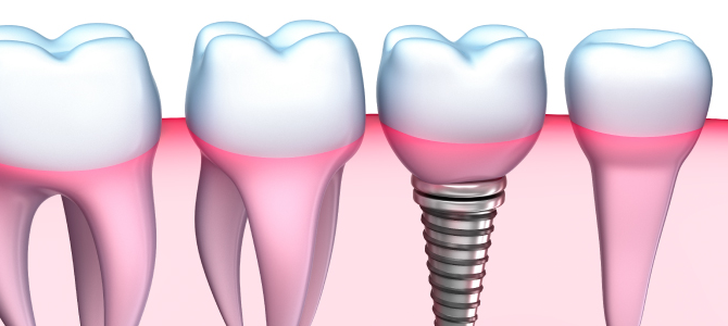 Affordable Dental Implants Treatment