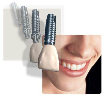 Affordable Dental Implants