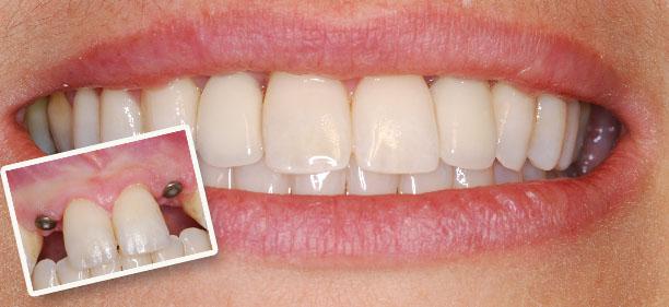 Bring Back Happy life with Dental Implants