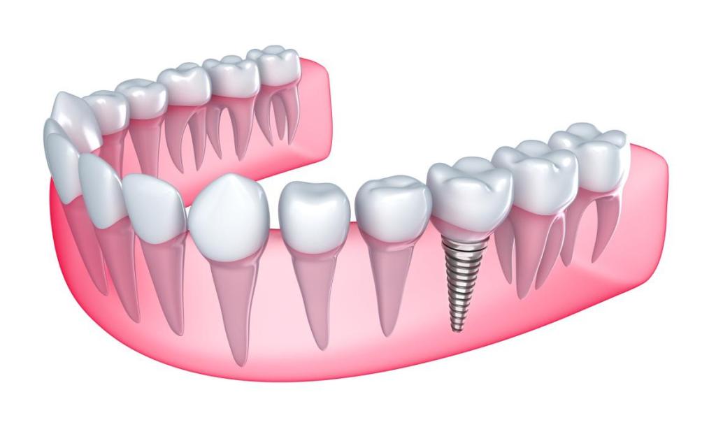 Bring Confidence With Dental Implants