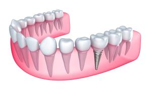 Pertinent Questions about Getting Dental Implants