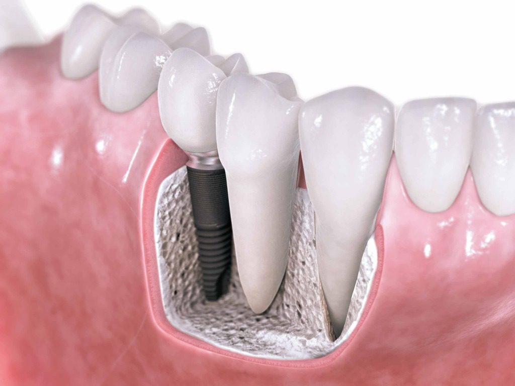 Cost Effective Dental Implant Treatments