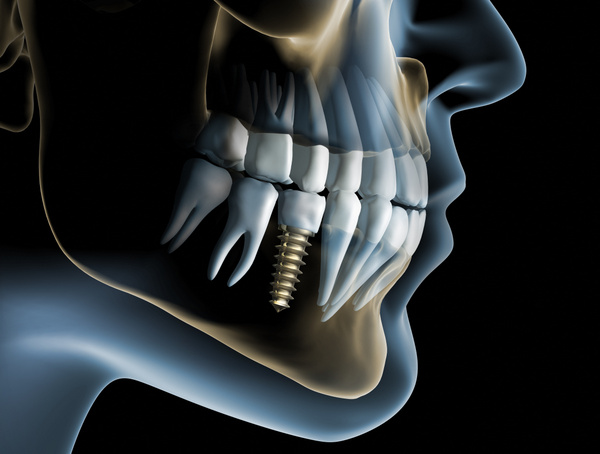 Dental Implants Professionals