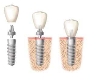 After a Dental Implant Procedure