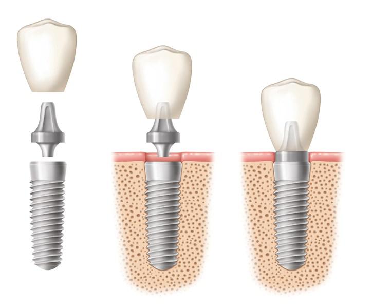 Affordable Dental Implants Melbourne