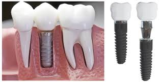 Cheap Dental Implants Melbourne