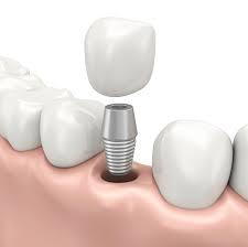 Favour Teeth Implants Over Dentures