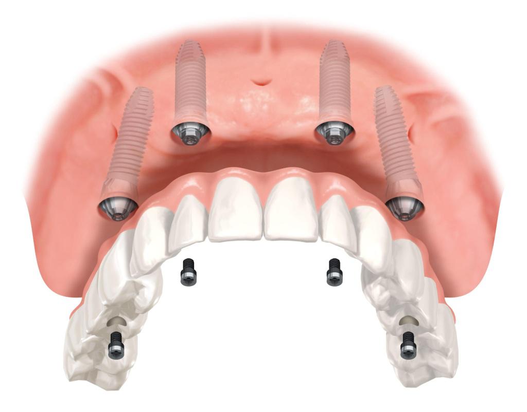Dental Implant Cost and Benefits