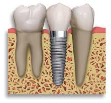 Dental Implants Treatment Melbourne