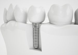Ask About Dental Implants