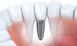 Dental Implants over Other Treatments