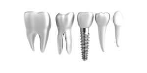 Dental Implant Procedure