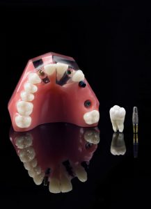 Perfect Tooth Implant Candidate