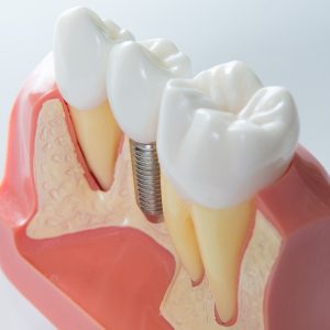 Eligible for Teeth Implants
