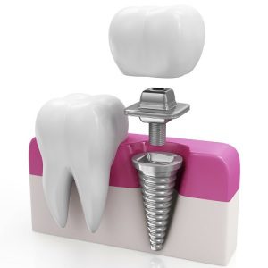 Getting Affordable Dental Implants is Easy