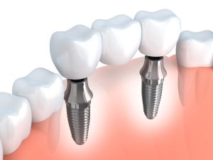 Advantages of Dental Implants