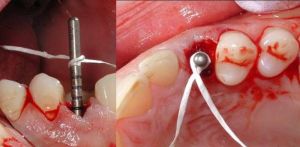 cost of dental implants