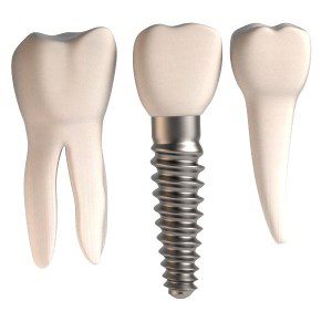 Dental Implants are better than Bridges in Tooth Replacement