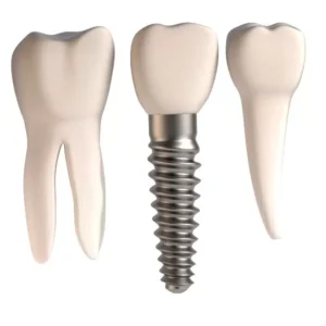 Implants-are-better-than-Bridges-in-Tooth-Replacement