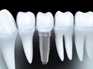 Dental implant