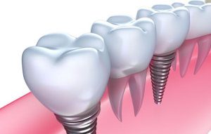 Dental implants in Melbourne