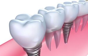 dental-implants-melbourne