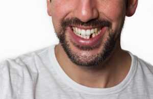 effects-of-missing-teeth