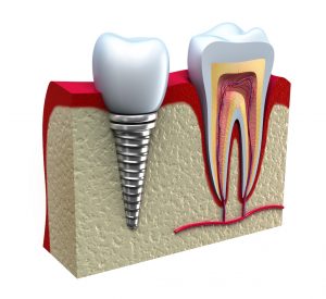 Dental Implant Procedure