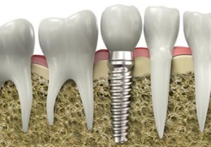 Dental implant requirements