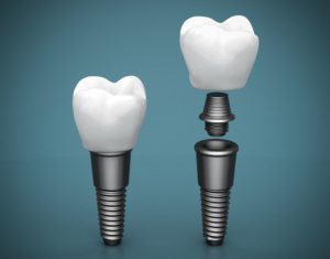 Single And Multiple Tooth Implants