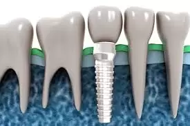 Commonly asked questions about dental implants