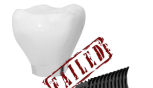 Prevent Dental Implant Failure