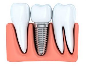 Dental Implants in Melbourne