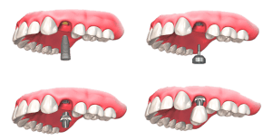 dental implants