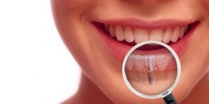 dental implants in Melbourne
