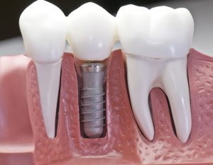 dental implants in Melbourne