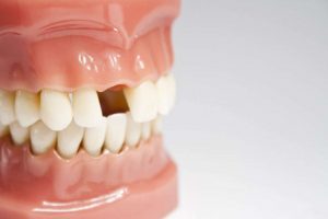 dental implants in Melbourne