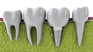 Bone grafting for dental Implants
