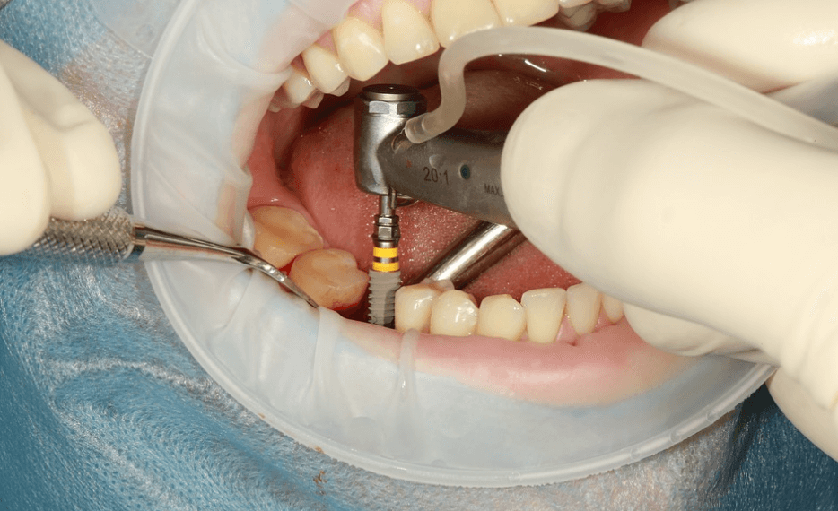 A Guide to Dental Implants Procedure Dental Implants