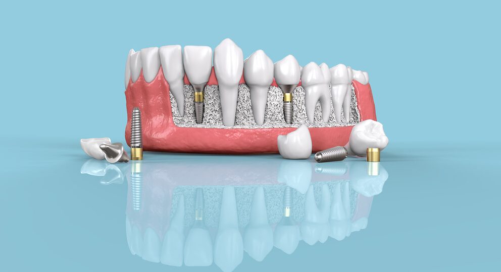 Digital Dental Implants Is it really worth it? Dental Implants