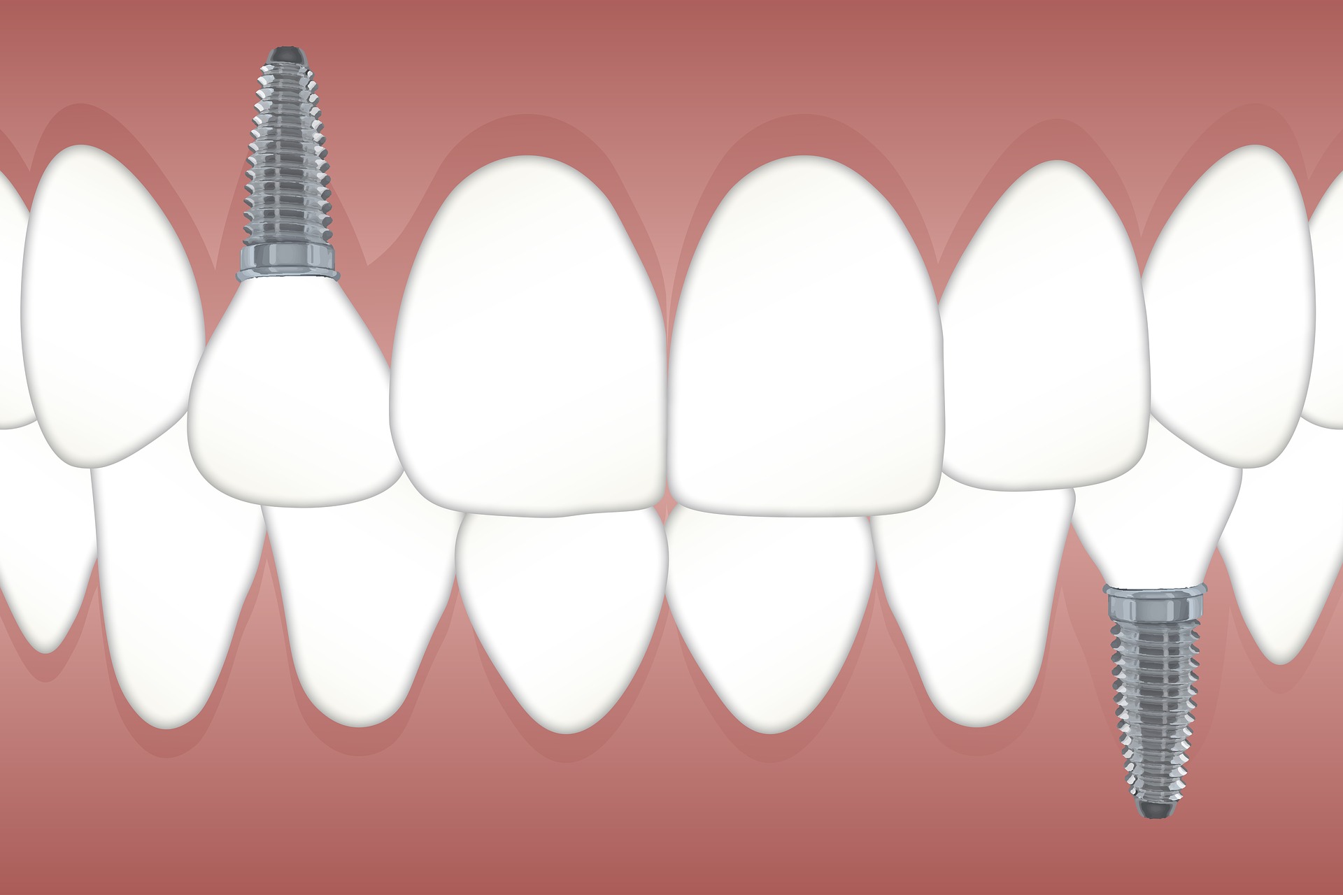 Do You Need Bone Graft To Receive Dental Implants? Signs to Watch For