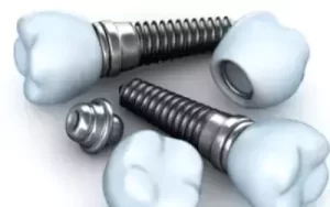 Dental Implant