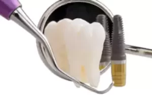 Dental Implant Cost