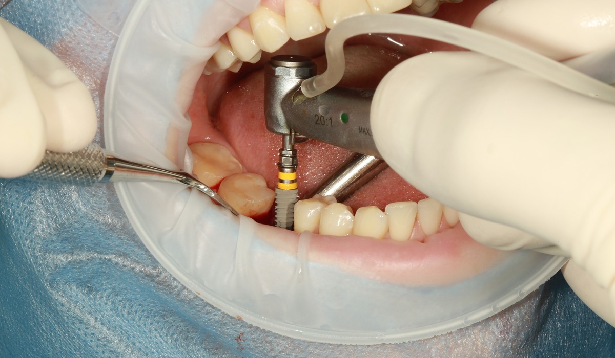 Understanding Dental Implant Cost What You Need to Know!!