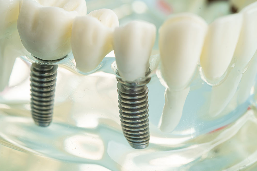 Dental Implant model in a transparent layer
